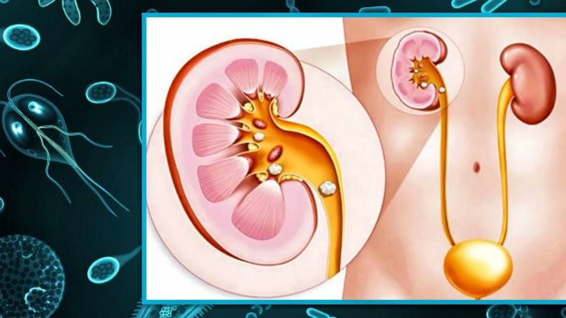 Конкременты в почках солевые. Мочекаменная болезнь, или нефролитиаз. Внутренние органы человека почки. Печеночно-каменная болезнь. Соленые почки.