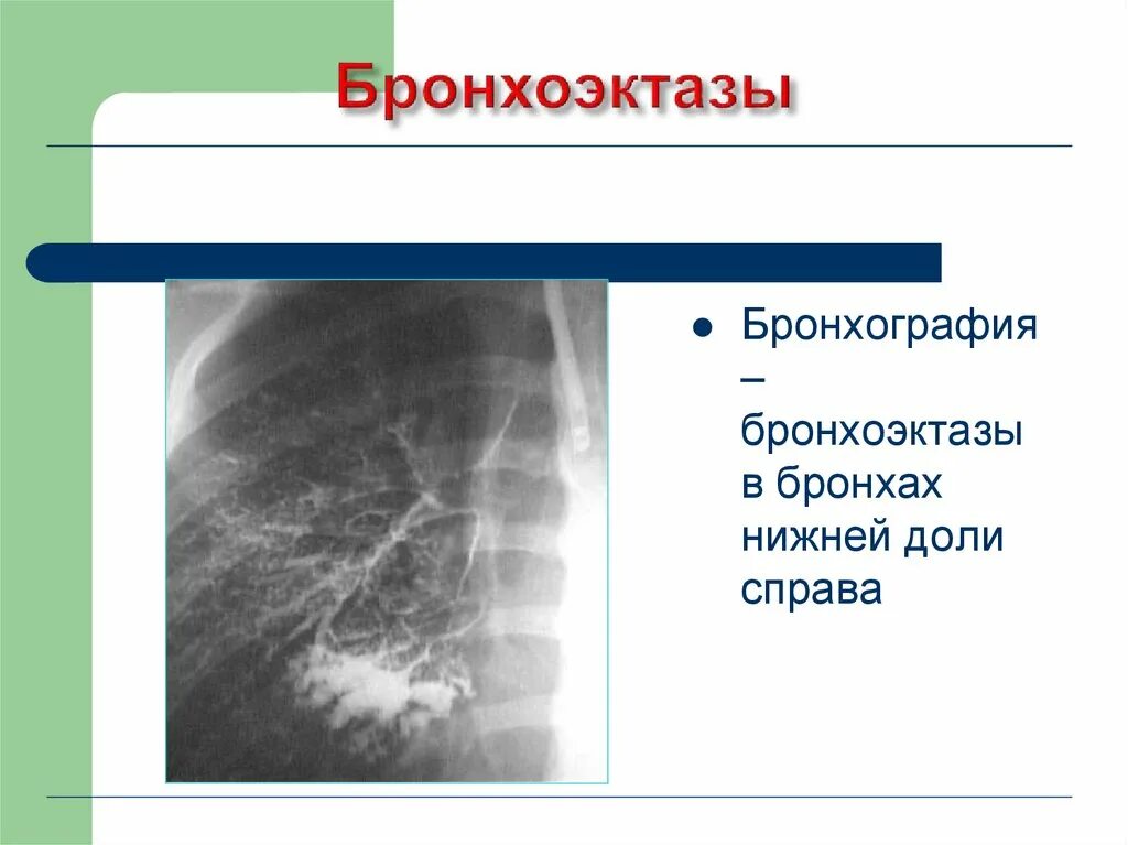 Что такое бронхоэктазы. Бронхоэктазы бронхограмма. синдром бронхоэктазов. бронхоэктазы средней доли.