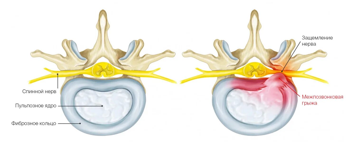 Грыжа мозговых оболочек освобождение нерва. Грыжа диска с5 с6. С5-с6 межпозвонкового диска. Грыжа межпозвоночного диска шейного отдела с5-с6. Межпозвонковые диски с5-с6.
