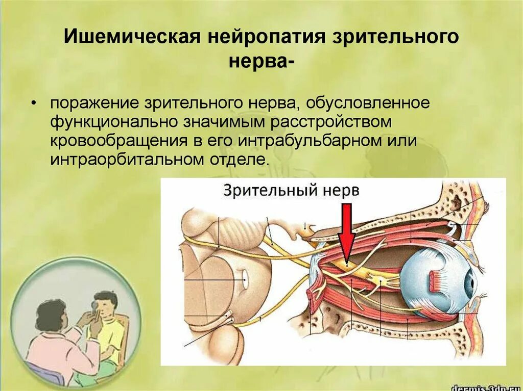 Задняя ишемическая нейропатия зрительного нерва. Передняя ишемическая невропатия зрительного нерва. Передняя ишемическая оптиконейропатия зрительный нерв. Ишемическая нейрооптикопатия зрительного нерва. Нейропатия глаза