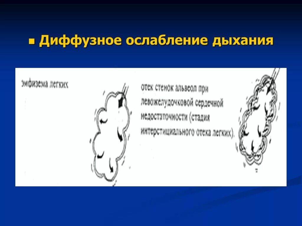 Диффузное дыхание характерно для. Диффузное дыхание. Диффузное ослабление дыхания. Диффузный Тип дыхания. Диффузное ослабление дыхания характерно для.