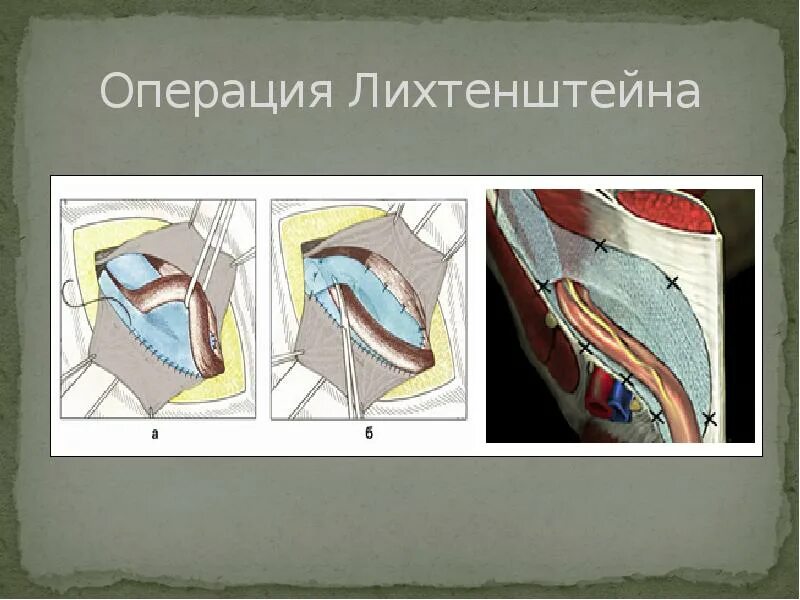 Паховая грыжа операция по Лихтенштейну. Операция Лихтенштейна герниопластика. Ненатяжная герниопластика по Лихтенштейну. Лихтенштейн операция паховая