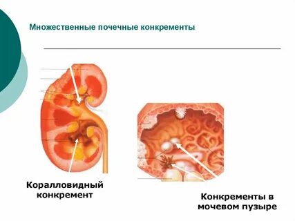 Множественные обеих почек