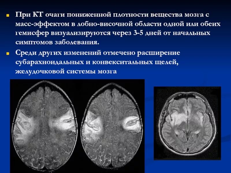 Нейросифилис поражение мозга. Единичные мелкоочаговые изменения белого вещества мозга. Очаговые изменения головного мозга при шизофрении. Перивентрикулярный лейкоареоз на кт. Перивентрикулярный лейкоареоз головного мозга на кт.
