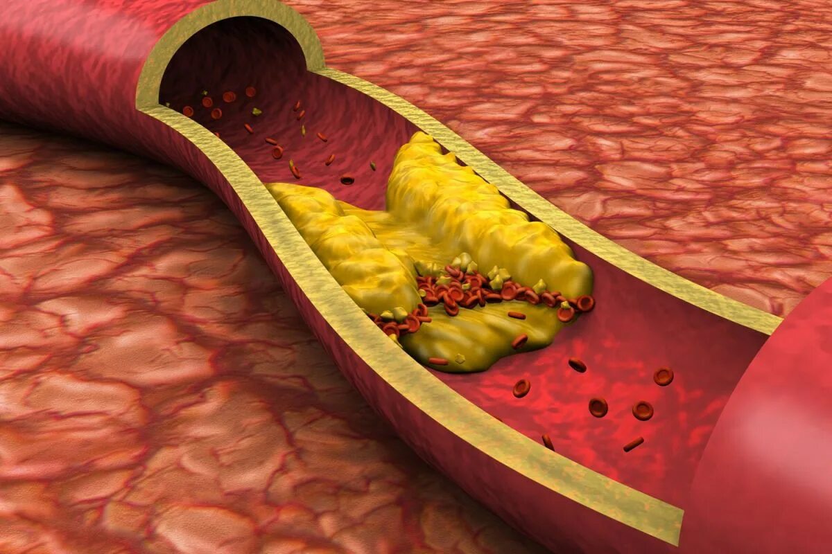 Холестерин к чему приводит. Атеросклероз (закупорка кровеносных сосудов). Холестериновые бляшки в сосудах. Гиперхолестеринемия дислипидемия. Атеросклерозная бляшка.