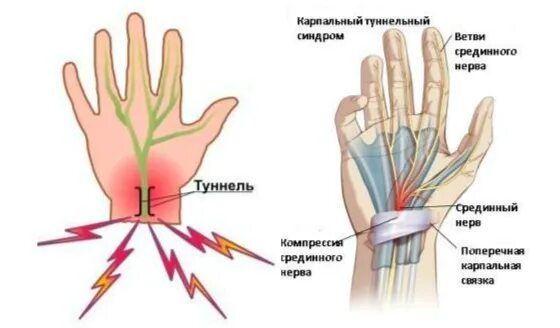 Лечение карпального канала кисти рук. Карпальный туннельный. туннельный синдром запястья кисти руки. карпальный канал кисти. карпальный канал срединного нерва.