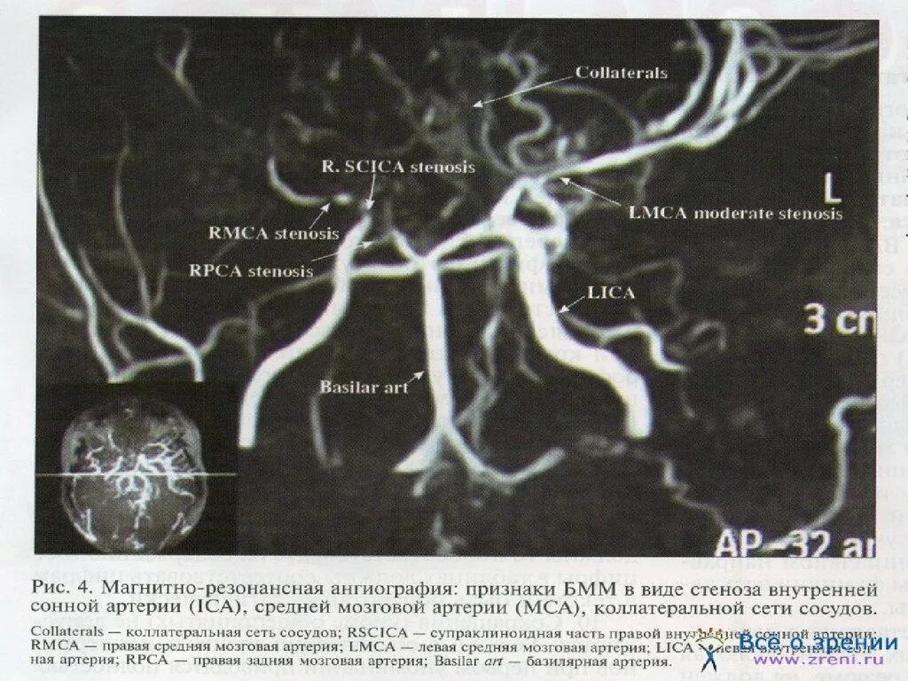 ДСА сосудов головного мозга. Артериальные аневризмы сосудов головного мозга. Аневризма поверхностной вены головы. Аневризма сосудов головного мозга стендовый доклад. Аневризма мозга простыми словами