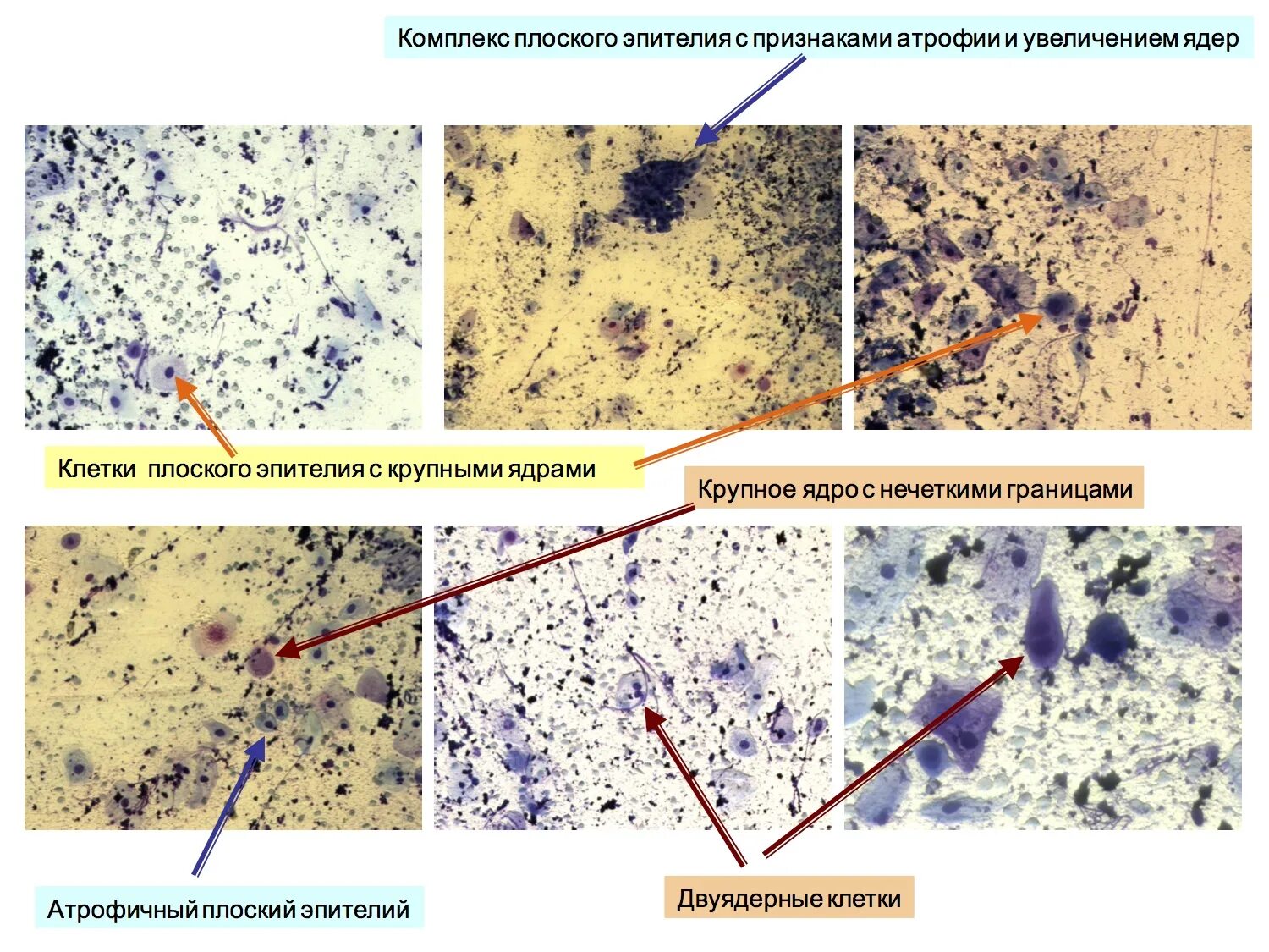Плоский эпителий в цитограмме. Атлас микроскопия гинекологических мазков. Цитология микроскопия обозначения. Трихомонады микроскопия нативный препарат. Промежуточно клеточный Тип мазка что это такое.