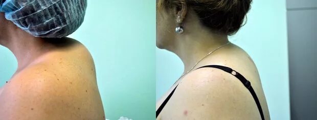 Горб на шее как называется. Лазерная липосакция вдовьего горба. липосакция холки (&quot;вдовий горб&quot;). холка вдовий горбик психосоматика. остеохондроз вдовий горб.
