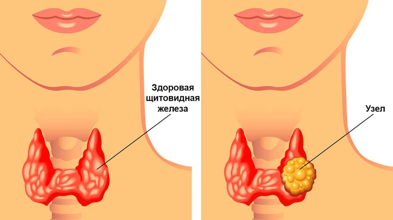 Почему появляются узлы. Многоузловой зоб щитовидки. Щитовидная железа зоб узлы. Тумор щитовидной железы. Многоузловой эутиреоидный зоб щитовидной железы.