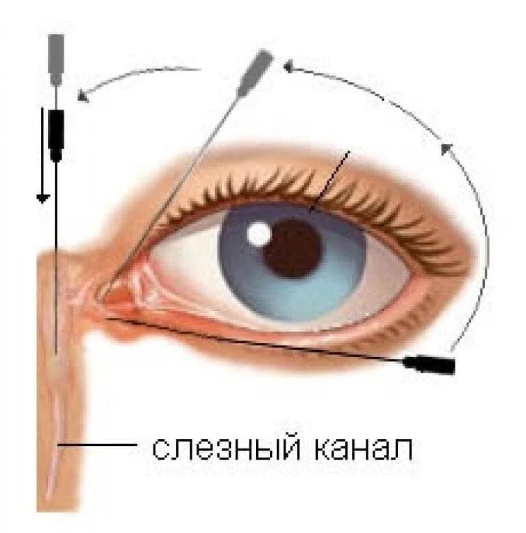 Как прочистить слезные каналы. Воспаление слезного канала дакриоцистит. Строение носослезного канала у грудничка. Зондирование глаза слезного канала. Лечение воспаления слезного мешка дакриоцистит.