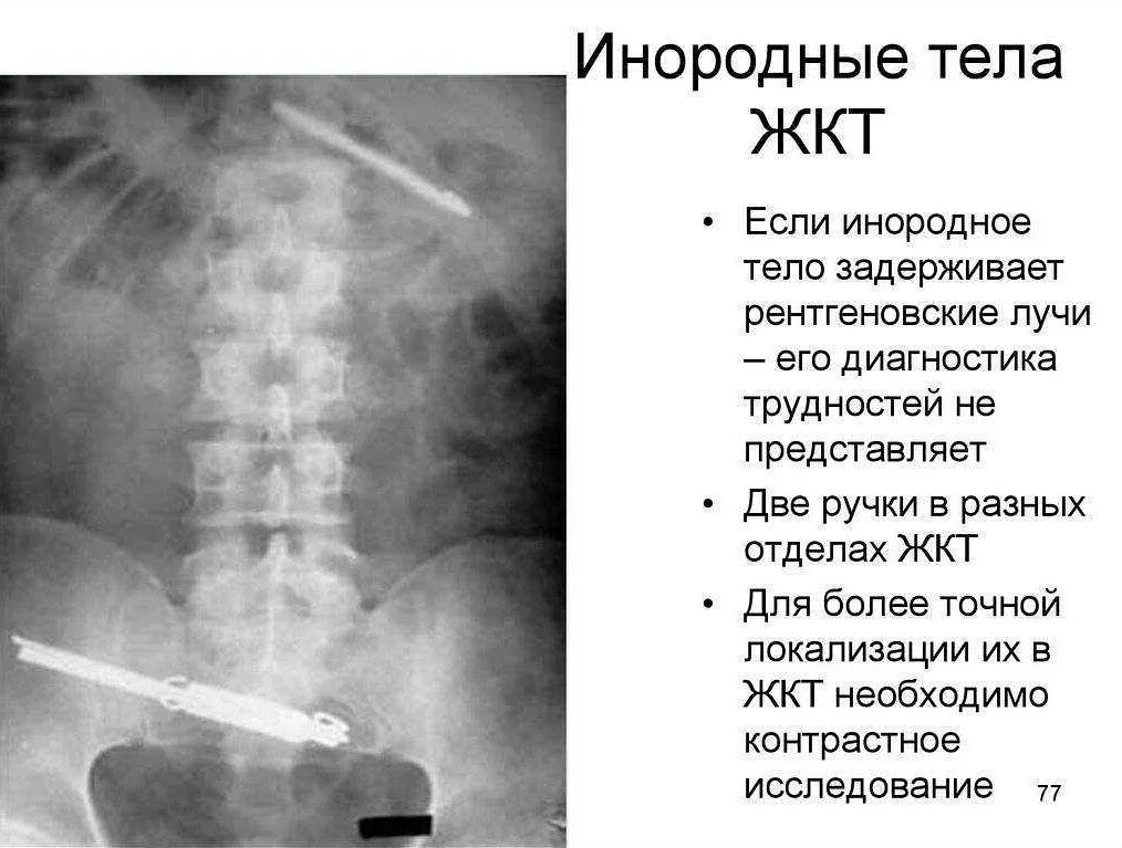 Энтеротомия инородное тело. Инородные тела сосудов. Инородное тело в желудке рентген. Инородные тела сосудов. Пневмоперитонеум рентген.