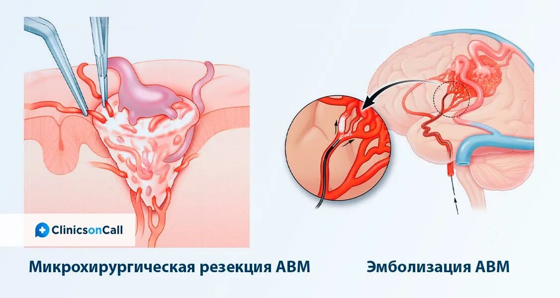 Сосудистая аномалия. Эндоваскулярная эмболизация сосудов. Артериально венозная мальформация сосудов. Артериальная мальформация сосудов.