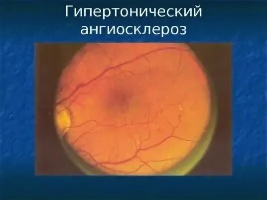Ангиосклероз сетчатки