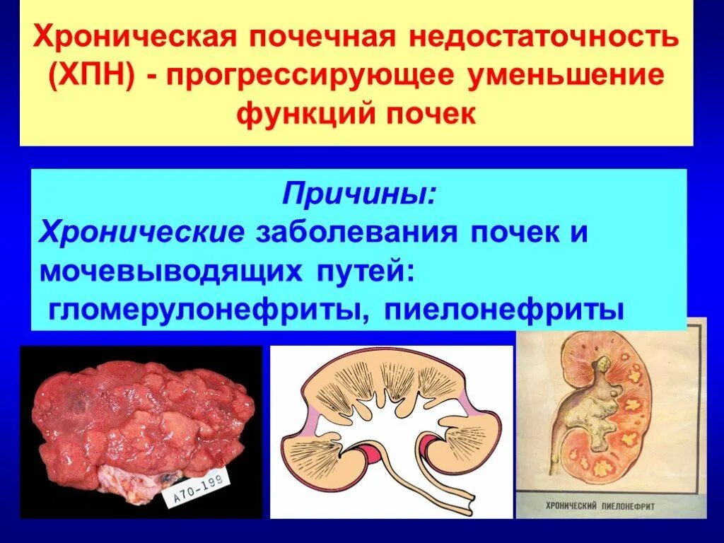 Хроническая почечная недостаточность. Хроническая почечна янедостаточностьь. Хроническая почечгая недостаточно. Почеченач недостатоочь. Причины почечных заболеваний