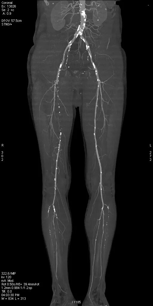 Аорты нижних конечностей. Синдром Лериша ангиография. Кт АГ нижних конечностей.