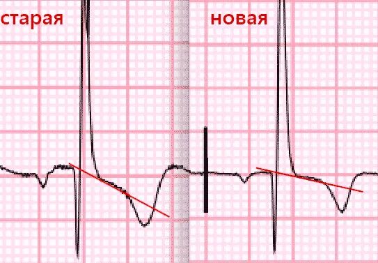 Эпизод депрессии st. Корытообразная депрессия сегмента St. Косонисходящая депрессия сегмента St. Корытообразное St на ЭКГ. Горизонтальная депрессия St на ЭКГ.