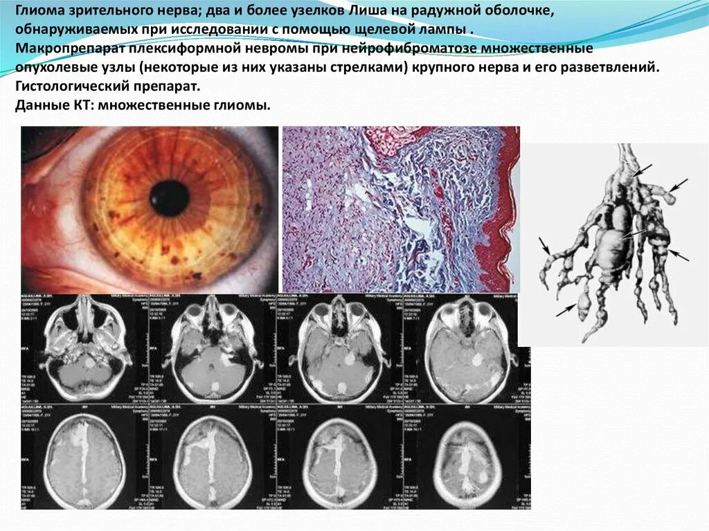 Клиника глиомы зрительного нерва:. Глиома зрительного нерва мрт. Нейрофиброматоз глиома зрительного нерва. Интракраниальная глиома зрительного нерва что это. Что такое глиома