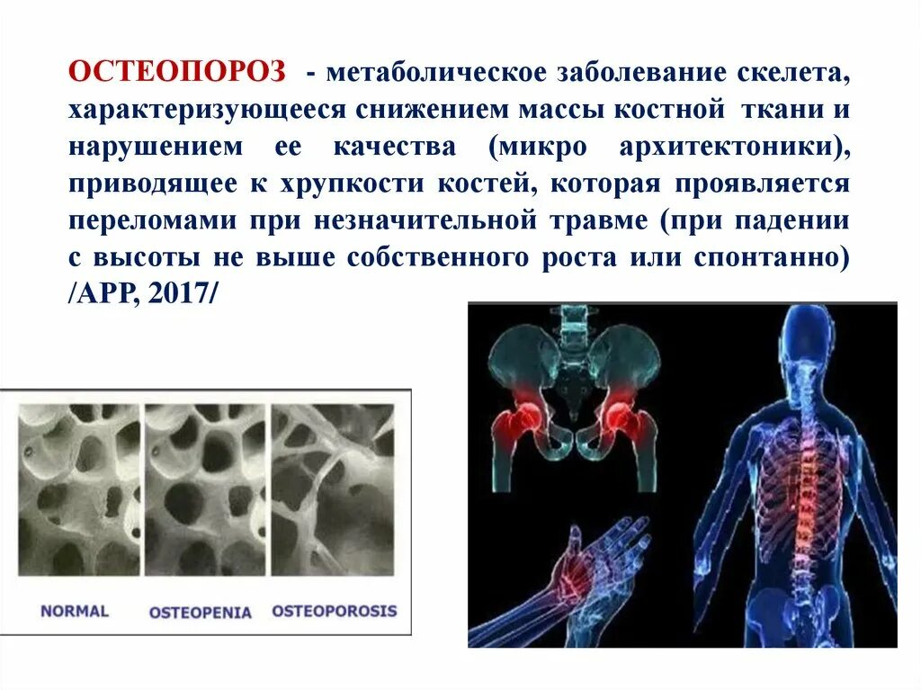 Лечение костных заболеваний. Остеопороз это заболевание. Вторичный остеопороз. Метаболические заболевания костей.