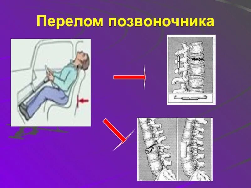 Ребенок сломал позвоночник. Перелом позвоночника презентация. Застарелый перелом позвоночника. Перелом костей позвоночника.