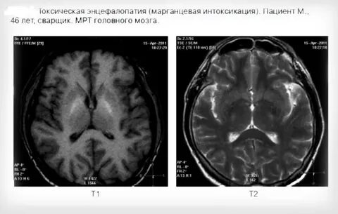 Токсическая энцефалопатия