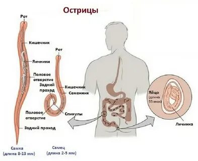 Острицы как избавиться