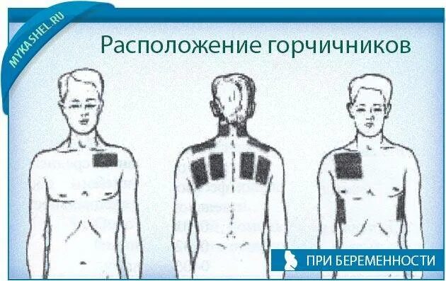 Можно ставить горчичники при сухом кашле. Схема расположения горчичников при бронхите. Как правильно поставить горчичники. Горчичники на спину при кашле. Схема горчичников при бронхите.