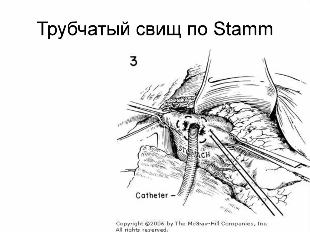 Как лечится свищ. Лигатурный свищ аппендицит.
