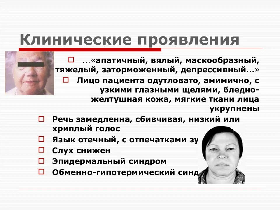 Лицо являющееся. Амимичное маскообразное лицо. гипотиреоз одутловатое лицо. лицо больного гипотиреозом. бледное маскообразное лицо.
