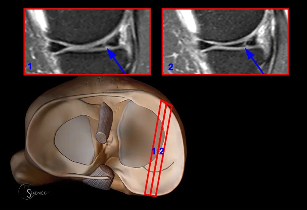 Передний рог коленного сустава. Повреждение медиального мениска мрт. Снимок мрт колена разрыв мениска. Повреждение корня мениска мрт. Разрыв рога медиального мениска.