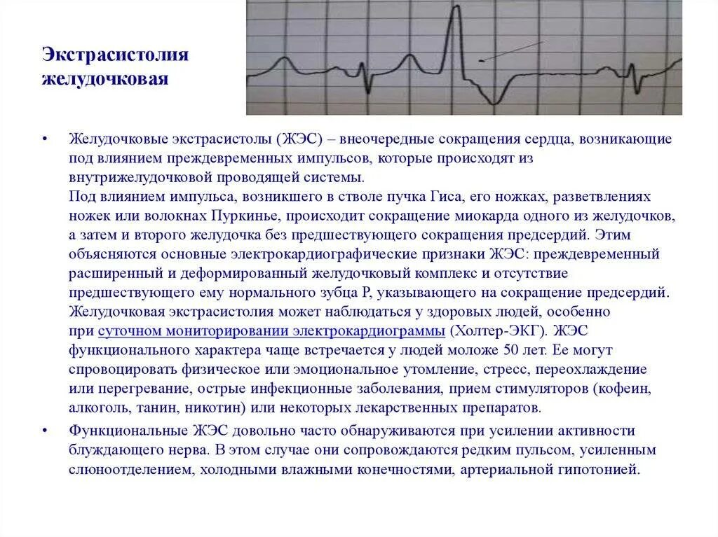 Что означает желудочковая экстрасистолия