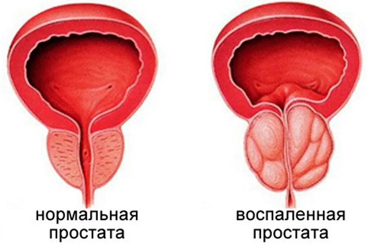 Простата урок. Увеличенная простата у мужчин.