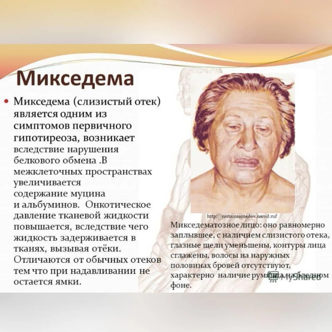 Мексидема. Болезни щитовидной железы микседема. Микседема при гипофункции щитовидной железы. Претибиальная микседема. Микседема болезнь симптомы.