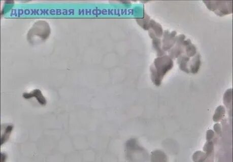 Дрожжевая инфекция