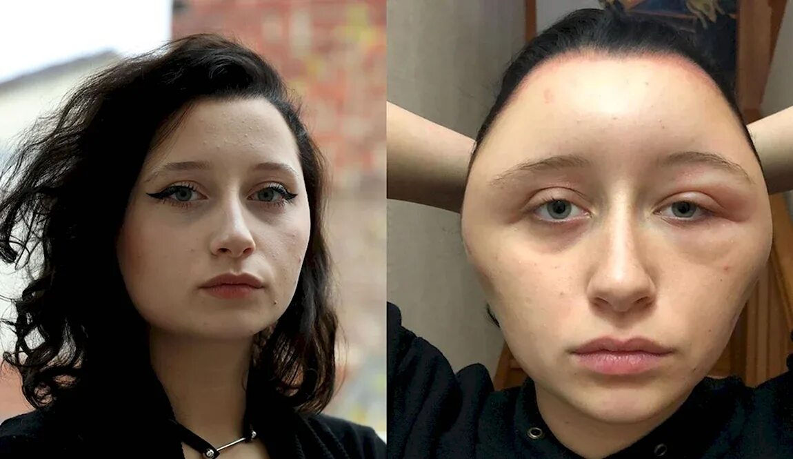 Аллергия на краску для воло. Аллергия на краску для волос на лице. Отек лица от краски для волос. Аллергия после покраски. Аллергическая реакция на окрашивание бровей.