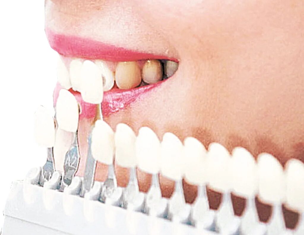 Клиника космостом омск на мира. Протезирование череповец. Стоматология лукашевича космостом омск. Металлокерамическая коронка мостовидный протез. Параллелометрия в стоматологии.