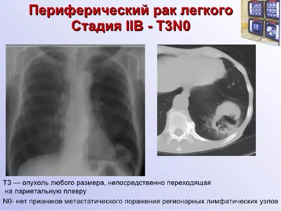 3 стадия рака с метастазами