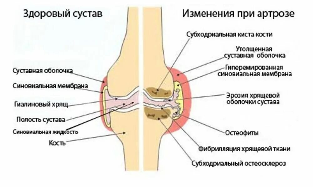 Где лечат артрозы