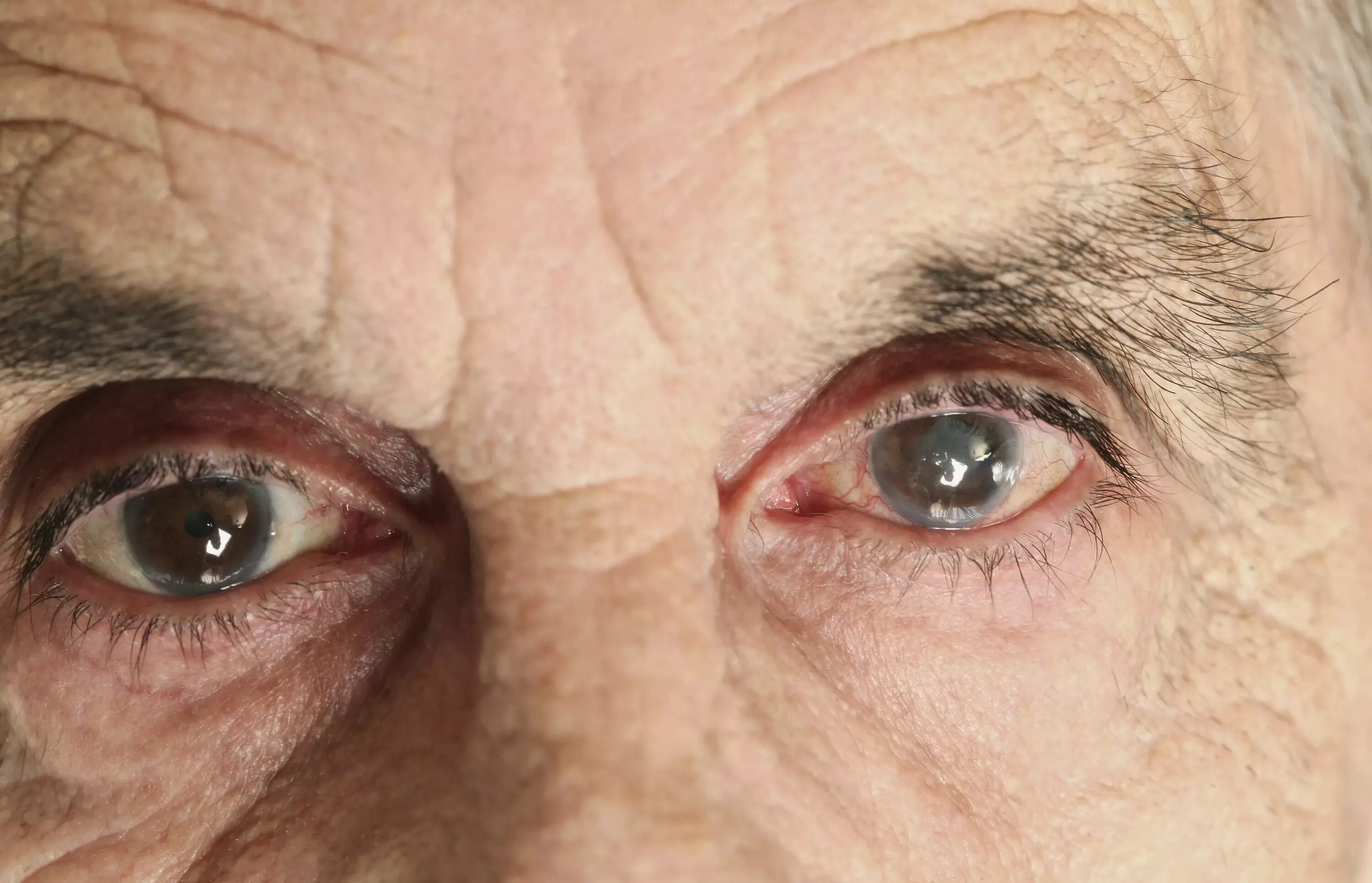 Один из супругов страдает глаукомой. Сенильная катаракта глаза. Катаракта светобоязнь. Сенильная диабетическая катаракта. Болезнь глаз катаракта.