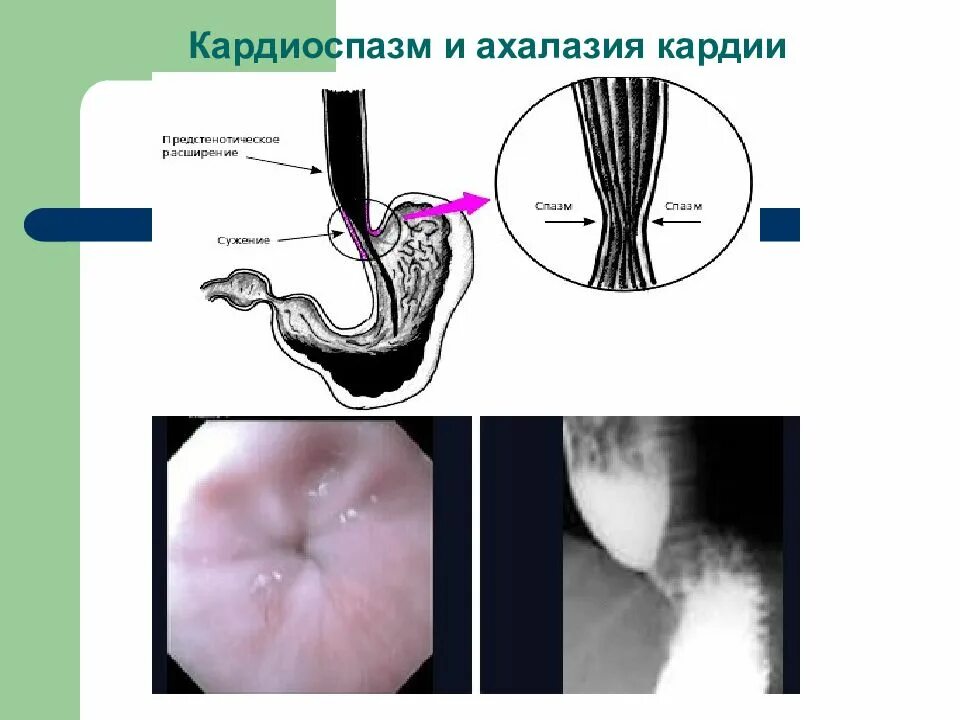 Пищевод не смыкается. Ахалазия пищевода эндоскопическая картина. Ахалазия кардии регургитация.