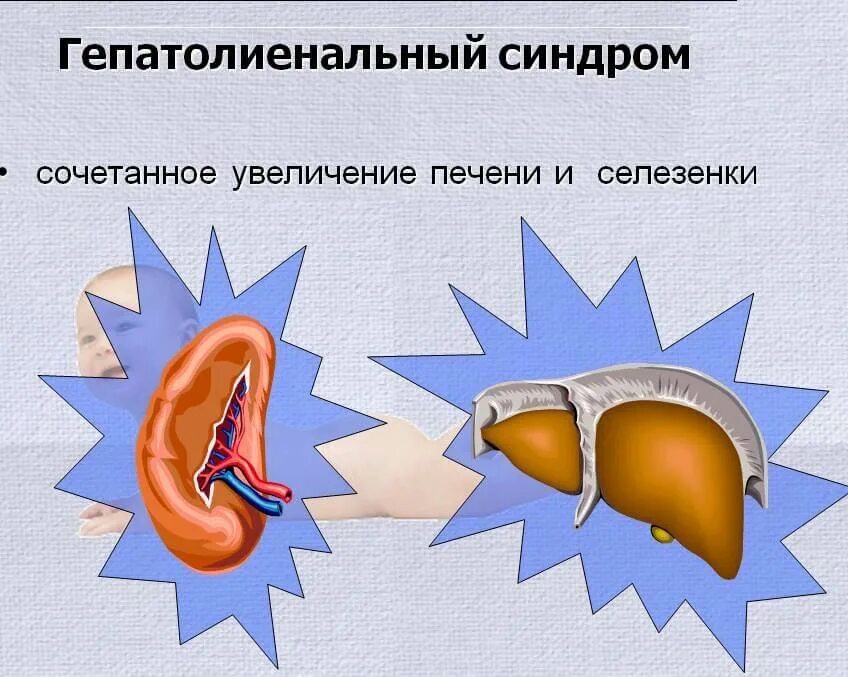 Увеличение печени это. Гепатолегочный синдром. Гератоминеальный синдром. Гепато ленальный синдром. Гепаторенальный и гепатолиенальный синдром.