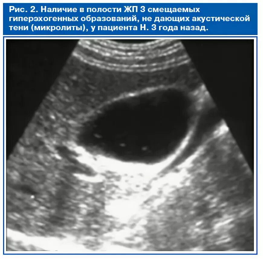Гиперэхогенный желчный пузырь УЗИ. Микролиты в желчном пузыре на УЗИ. Гиперэхогенный сладж. Взвесь в желчном пузыре на УЗИ.