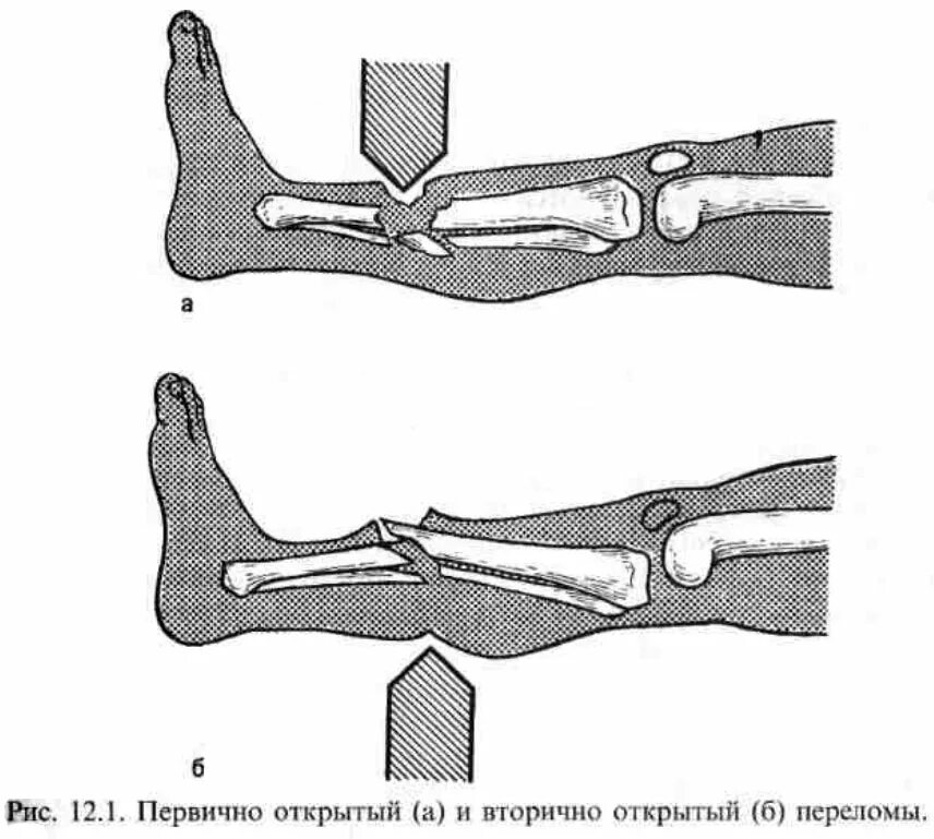 При открытом переломе отломки в ране. Первично открытые и вторично открытые переломы. Пулевое ранение большеберцовой кости. Первично открытый перелом. Открытый перелом костные отломки.