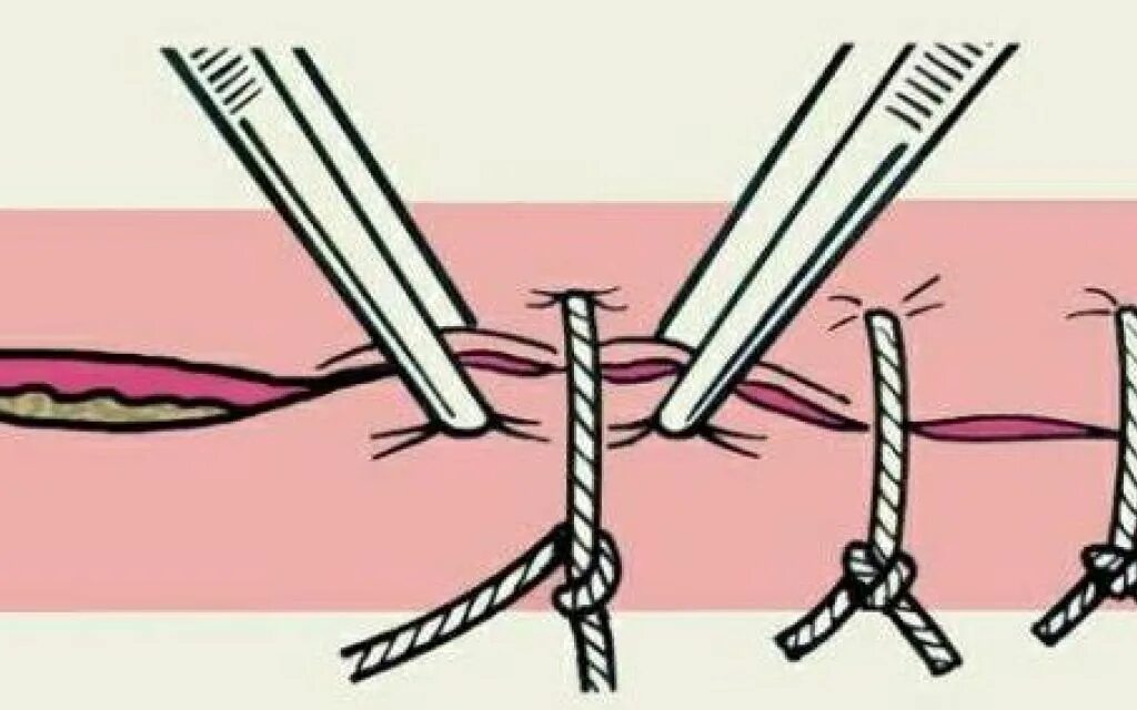 Техника наложения хирургических швов