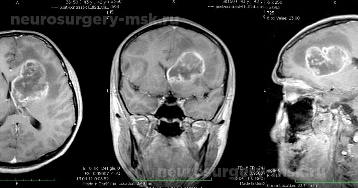 Глиобластома головного мозга. Опухоль мозга глиобластома. Глиобластома лобной доли.