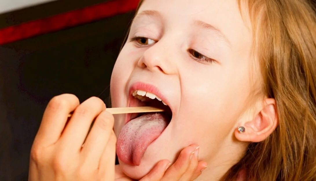 Герпетический стамоти. Афтозный стоматит сеттона. Инфекции полости рта у детей. Ангина симановского-плаута-венсана. Герпетический стоматит венсана.