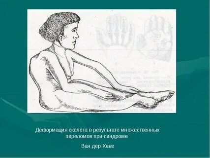 Синдром ван дер