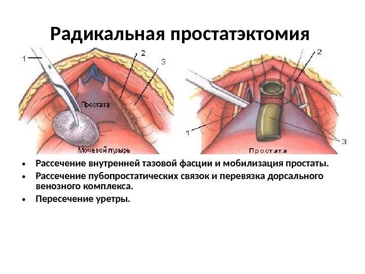 Удаление простаты форум