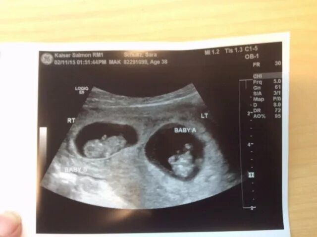 УЗИ 8 недель беременности двойня. УЗИ 10 недель беременности двойня. УЗИ 9 недель беременности двойня.