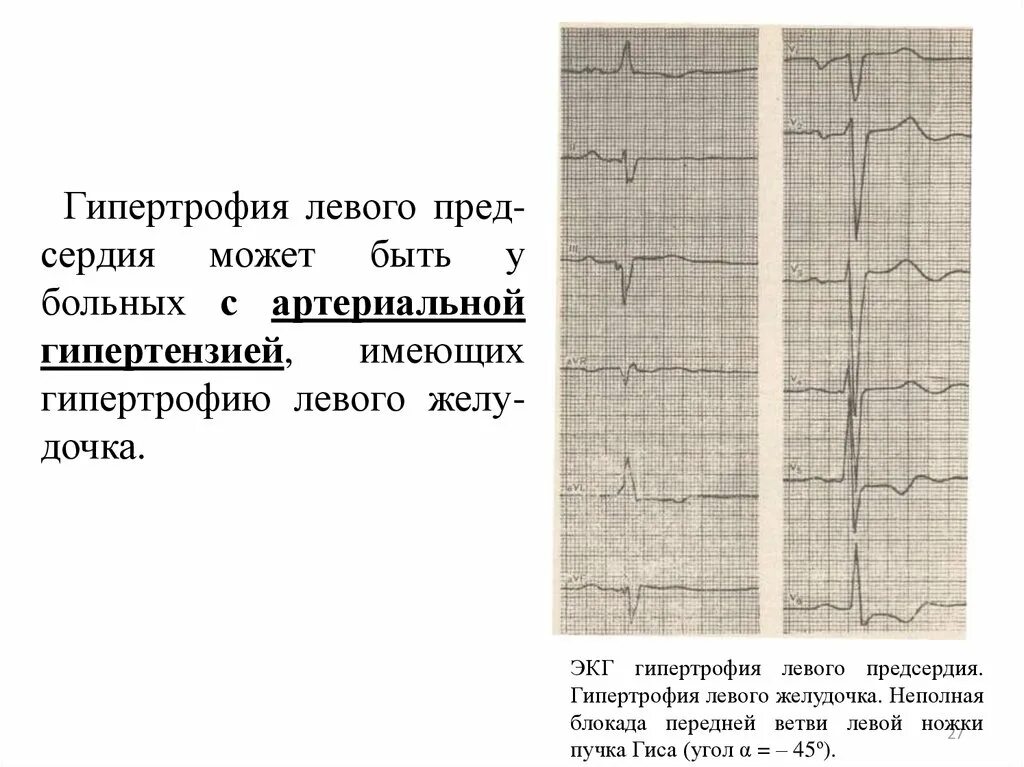 Неполная блокада передней. ЭКГ при гипертрофии левого желудочка при артериальной гипертензии. ЭКГ при гипертрофии левого желудочка. ЭКГ при гипертрофиях различных отделов сердца. ЭКГ при гипертрофии левого предсердия.